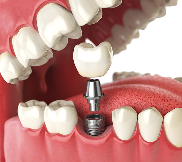 West Valley City Will I Need a Bone Graft for Dental Implants