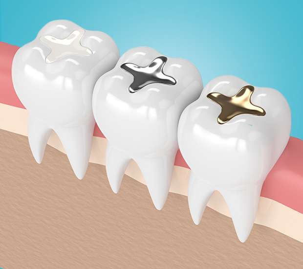 West Valley City Tooth Colored Fillings