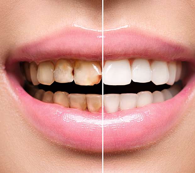 West Valley City Dental Implant Restoration