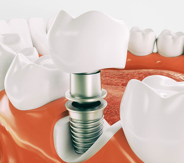 West Valley City Dental Implant Restoration
