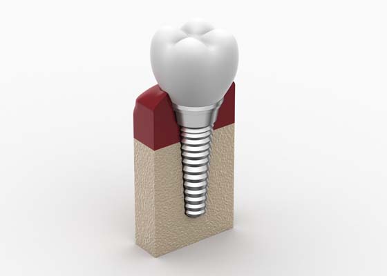 Bone Graft Procedure For Dental Implants