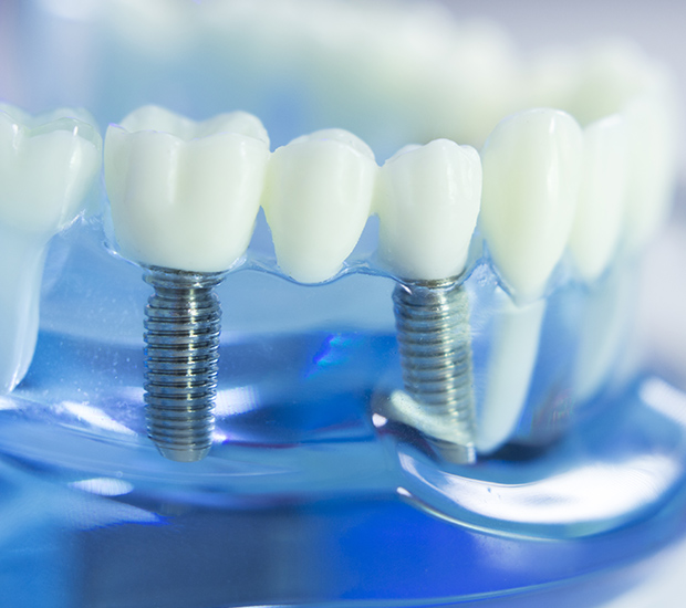 West Valley City Dental Implants