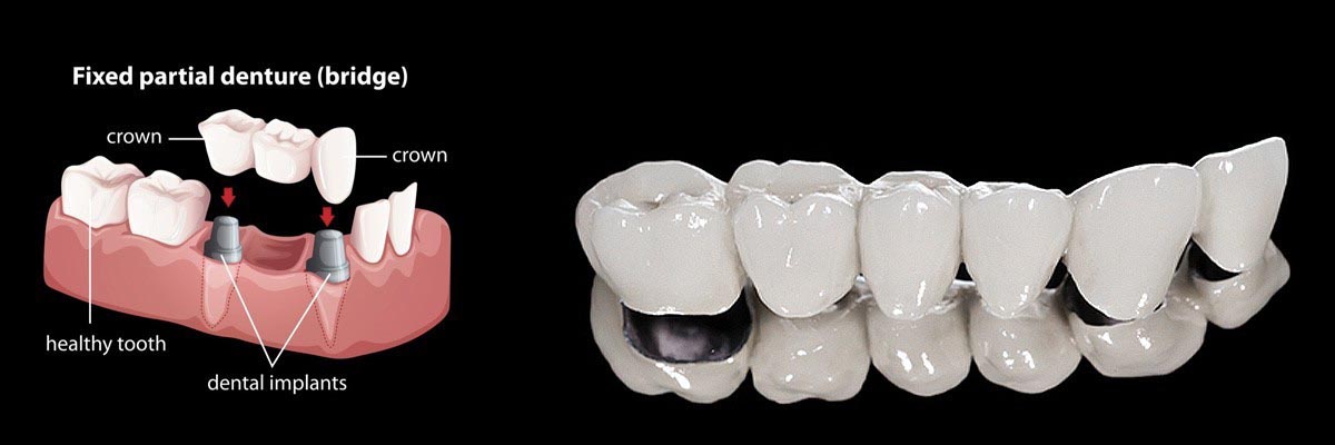 West Valley City Dentures