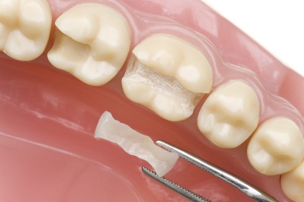 What Are Dental Fillings Used For?