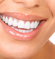 Teeth Whitening Services West Valley City, UT