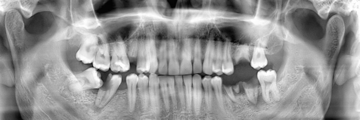West Valley City Wisdom Teeth Extraction